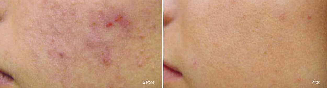 Vivace Actual Patient Results Before & After